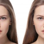 Get Safe Revision Rhinoplasty Procedure Done by Compassionate Doctors