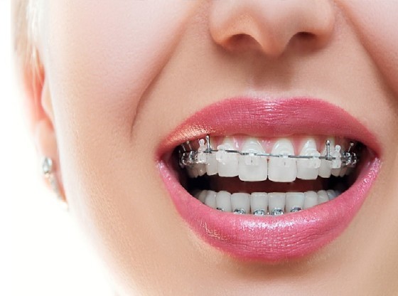 dental braces8