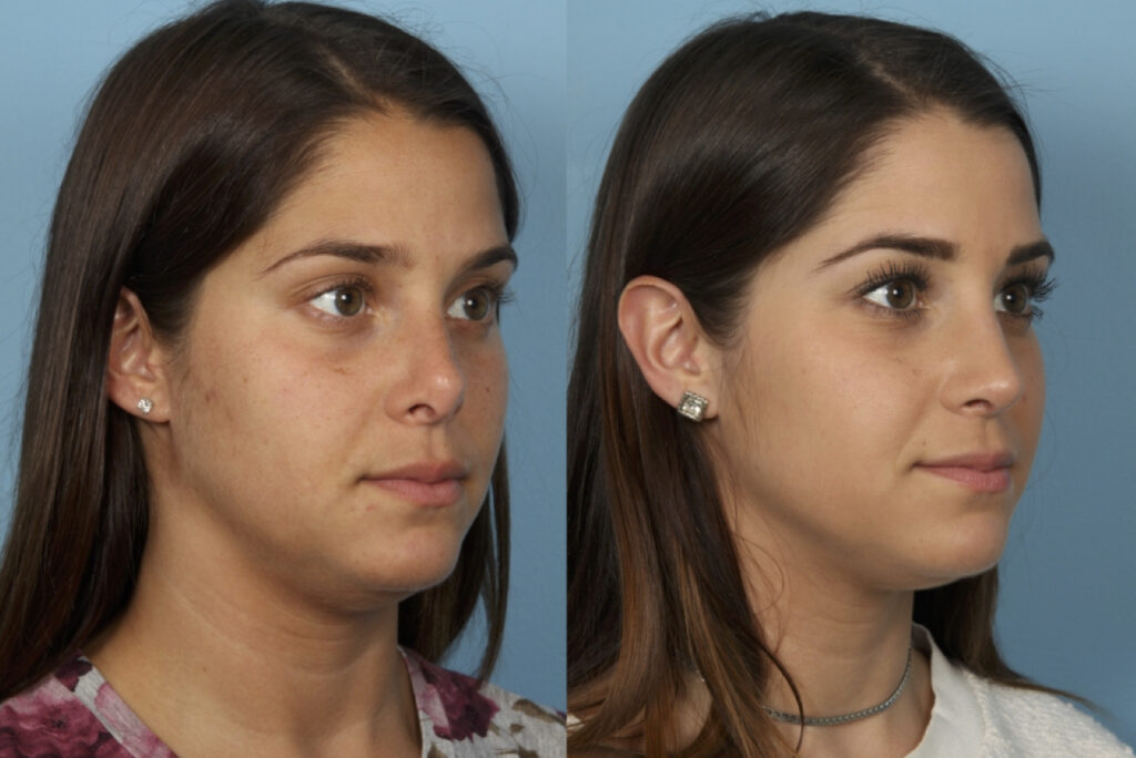 Rhinoplasty2