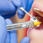 Most Common Dental Emergencies