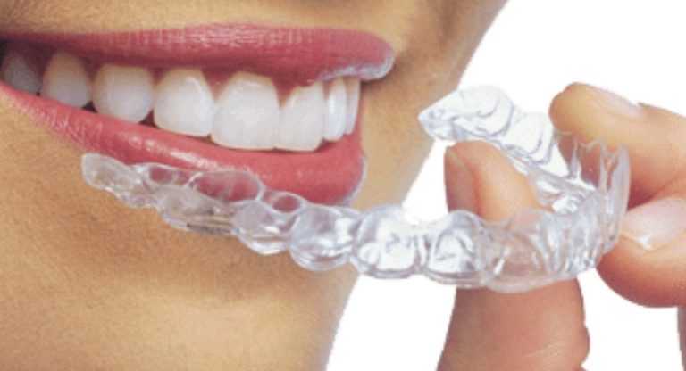 Invisalign What Is It And Why Should You Have It