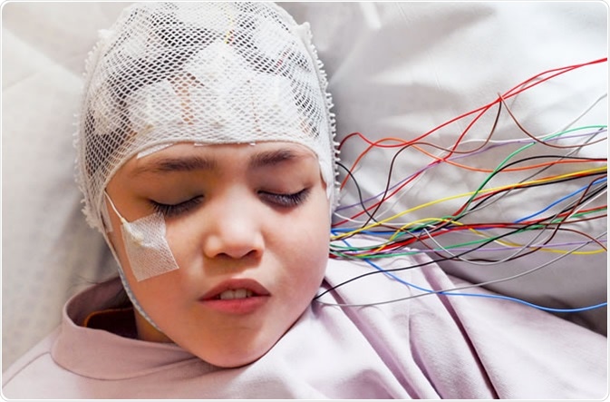 Epilepsy Here is A Guide To Treatment And Diagnosis