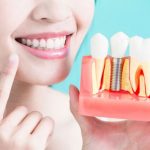 dental implants in Vancouver