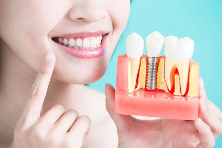 dental implants in Vancouver