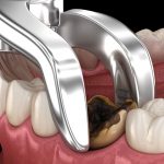 Wisdom Tooth Extraction Singapore