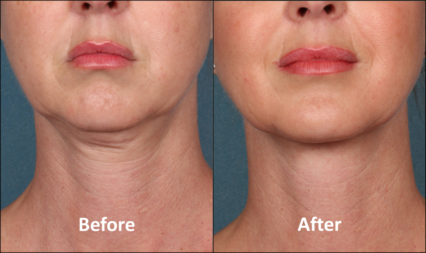 double chin removal