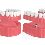 Dentures or Dental Implants, Which One to Choose?