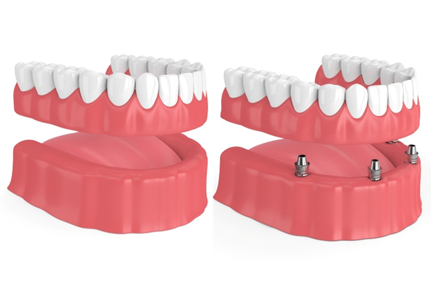 Dentures or Dental Implants, Which One to Choose?