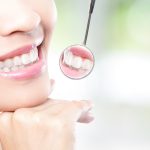 A Comparison Between Dental Veneers & Crowns