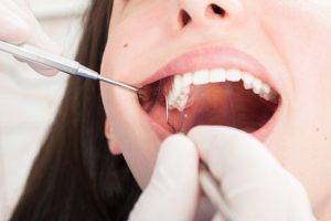 The Long-Term Effects of Ignoring a Cracked Tooth